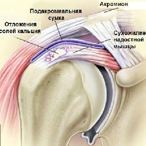 Как лечить повреждение сухожилия надостной мышцы плеча