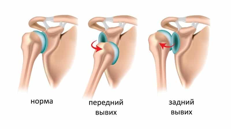 Как лечить растяжение связок плечевого сустава