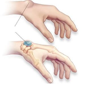 Как лечить синовиальную кисту