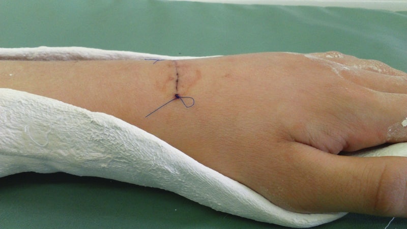 Как лечить синовиальную кисту