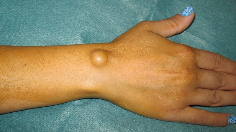 Как лечить синовиальную кисту