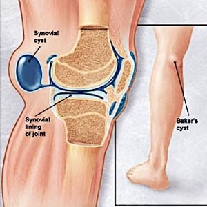 Как лечить синовиальную кисту