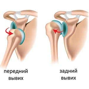 Как лечить врожденный вывих бедра