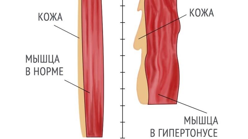 Гипертонус мышц