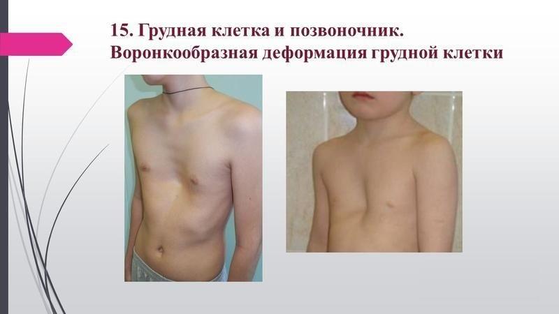 Какие бывают деформации грудной клетки
