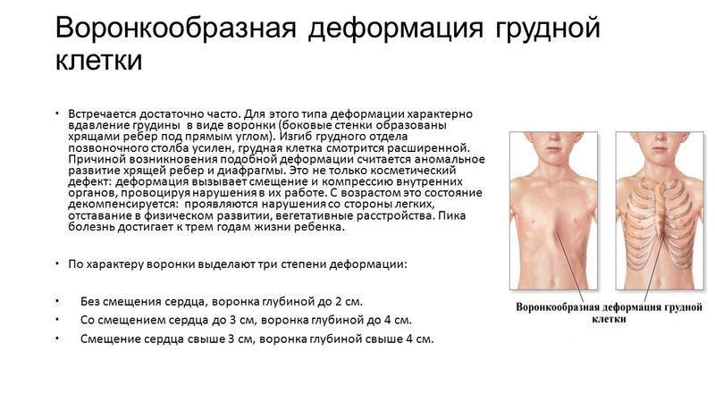 Какие бывают деформации грудной клетки