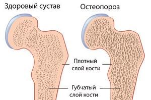 Какие препараты кальция лучше при остеопорозе