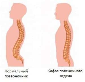 Как лечить поясничный кифоз