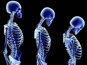 Как лечить шейный кифоз