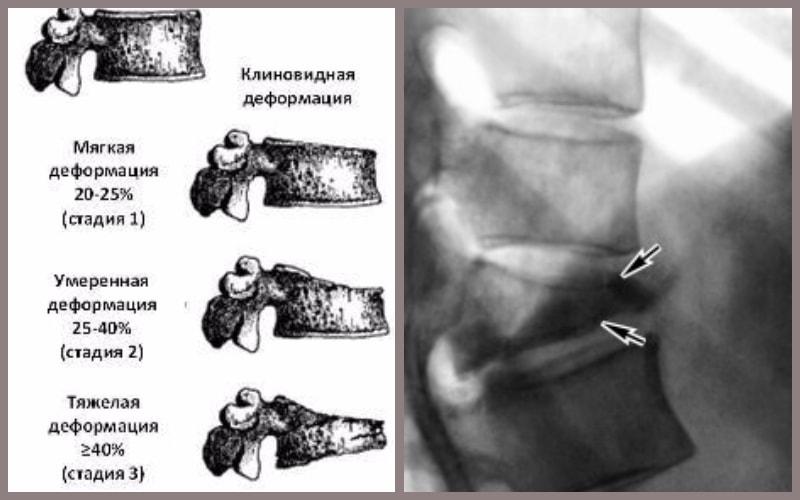 Клиновидная деформация позвонка