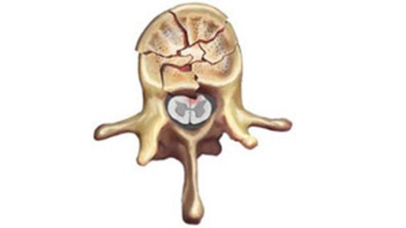 Как лечить осколочный перелом позвоночника
