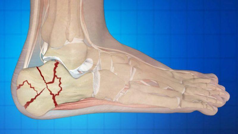 Как лечить осколочный перелом позвоночника