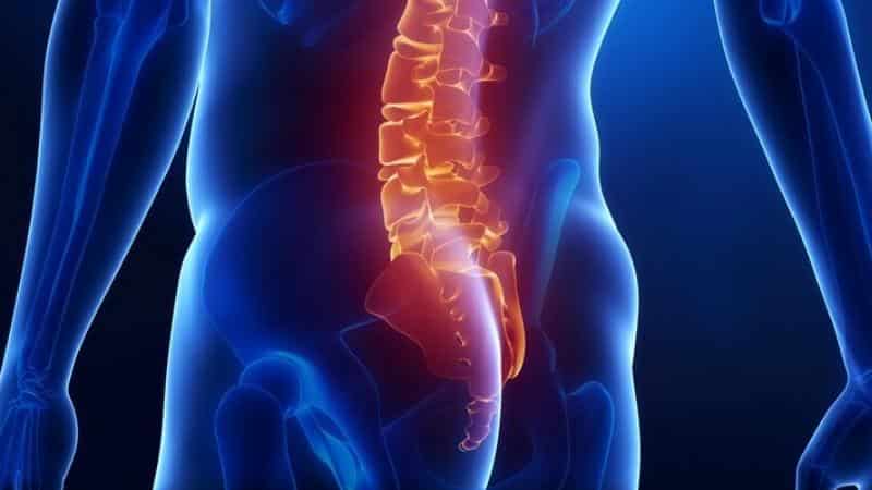 Как лечить артроз копчика