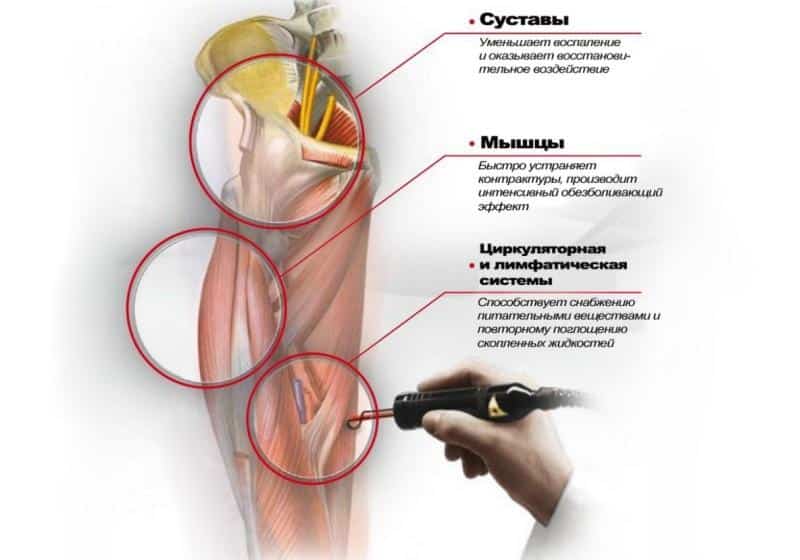 Польза лазеротерапии