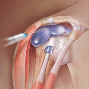 Как делать блокаду плечевого сустава