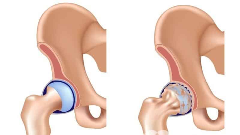 Как лечить деформирующий артроз тазобедренного сустава