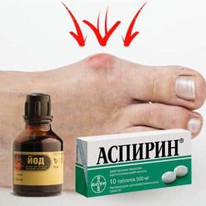 Как лечить косточки на ногах йодом и аспирином