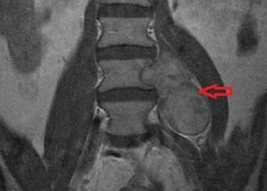 Как лечить невриному позвоночника