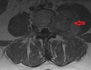 Как лечить невриному позвоночника