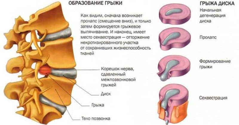 Секвестрация грыжи