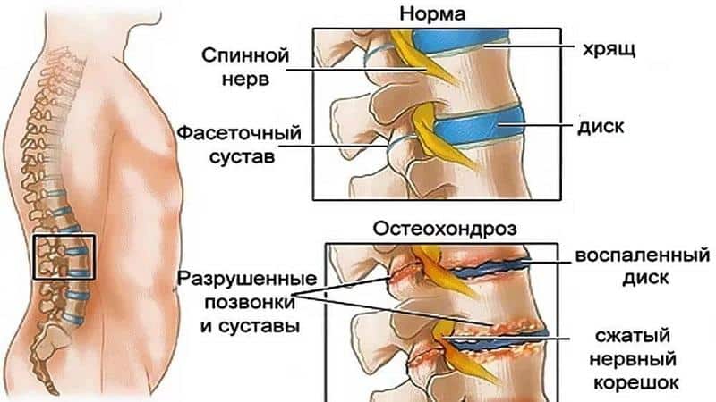 Что такое люмбализация позвонка