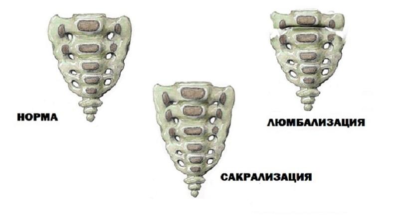 Что такое люмбализация позвонка