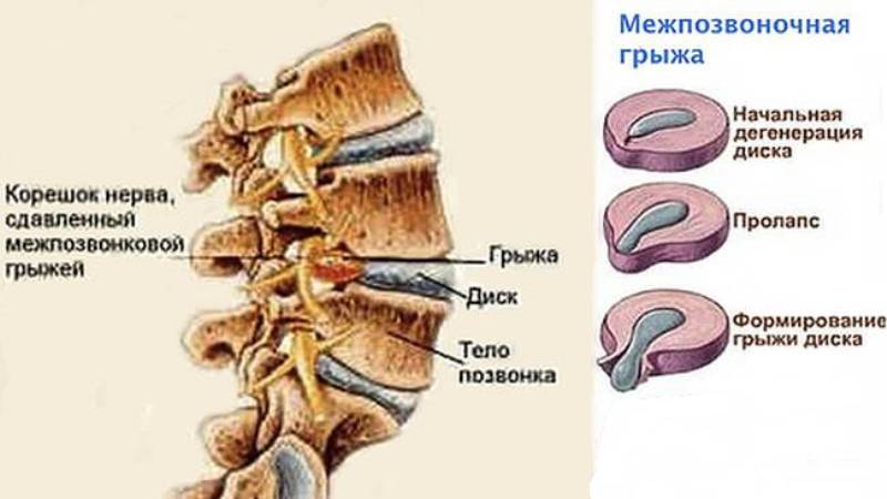 Как лечить межпозвоночную грыжу поясничного отдела