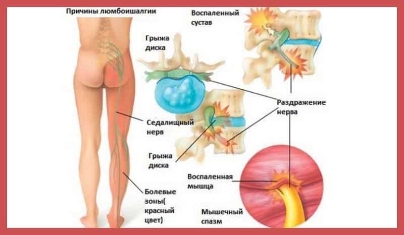 Люмбоишиалгия