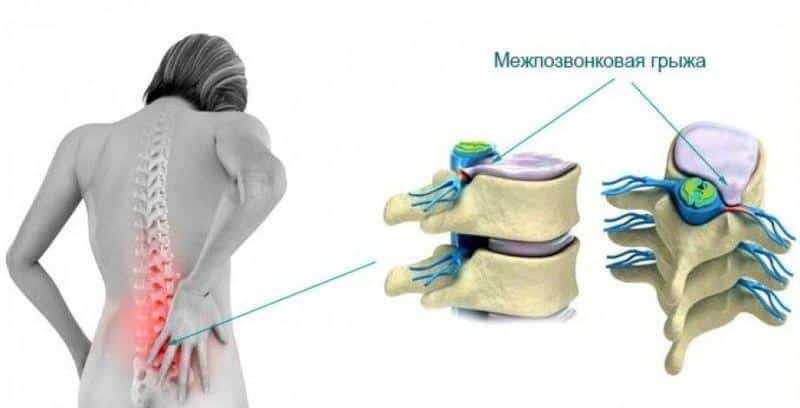 Помогает ли массаж при грыже позвоночника