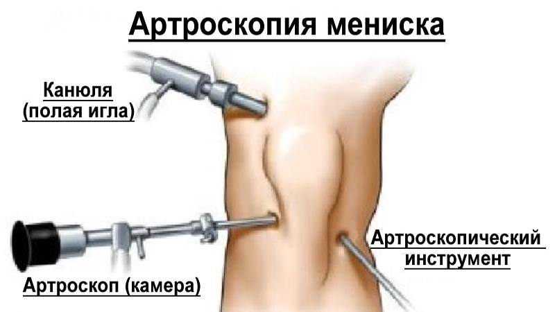 Операции на коленном суставе