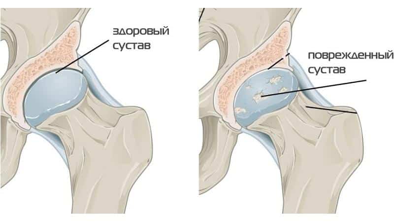 Как лечить остеоартроз периферических суставов