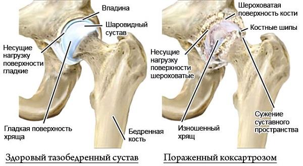 Как лечить остеоартроз тазобедренных суставов