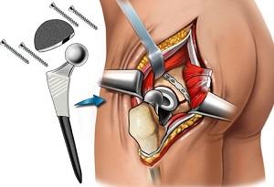 Как лечить остеоартроз тазобедренных суставов