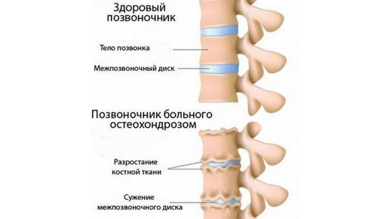 Симптомы и особенности лечения остеохондроза в зависимости от его степени