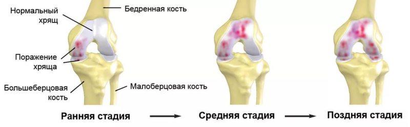 Степени пателлофеморального артроза