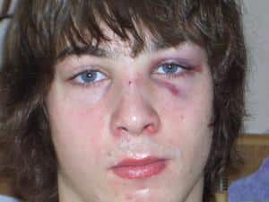 Как лечат перелом носа