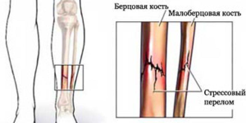 Как лечить перелом берцовой кости