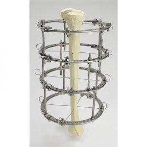 Как лечить перелом берцовой кости