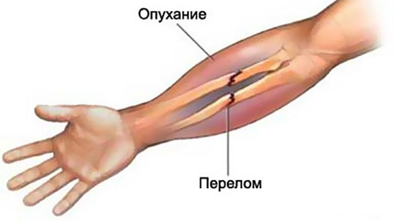 Как лечить перелом предплечья