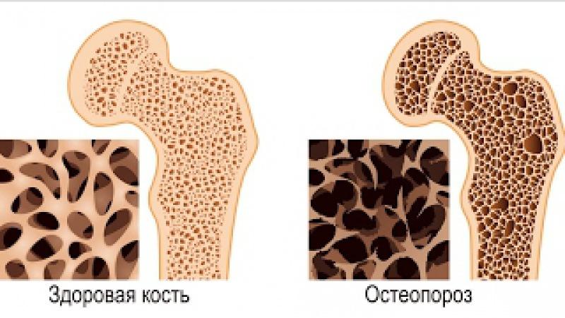 Как лечить перелом ребра