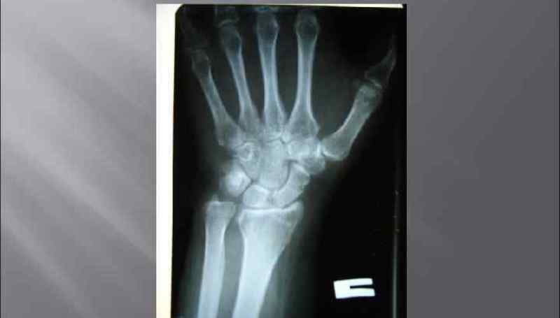 Как лечить перелом шиловидного отростка