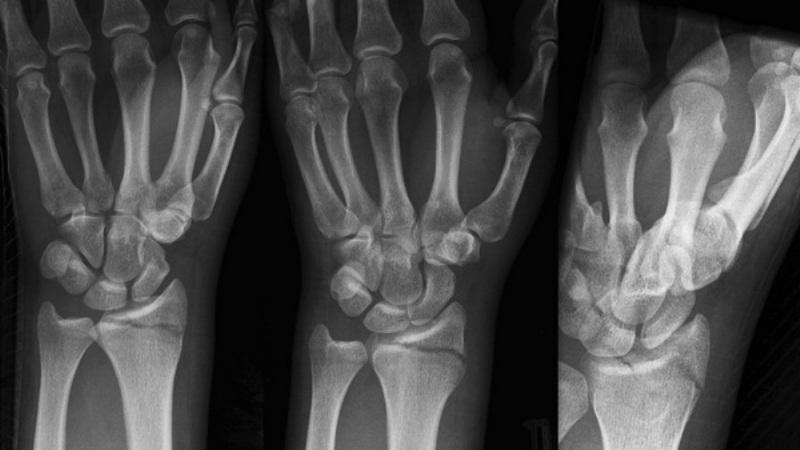 Как лечить перелом шиловидного отростка