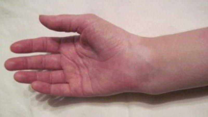 Как лечить перелом шиловидного отростка