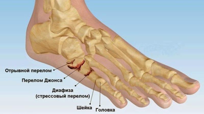 Как лечить перелом стопы