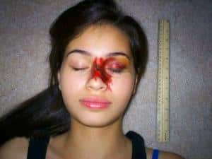 Как лечат перелом носа