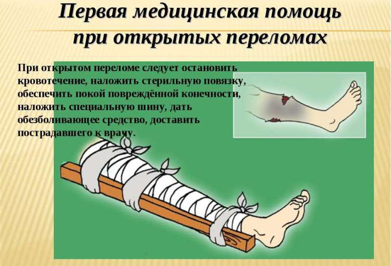 Помощь при открытом переломе