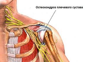 Как лечить остеохондроз плечевого сустава