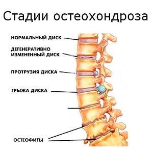 Что делать, если хрустит позвоночник