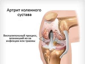 Как лечить подагру коленного сустава