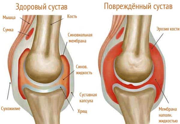 Как лечить артрит коленного сустава
